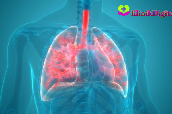 Mengenal Pneumonia Bilateral dan Pengobatannya