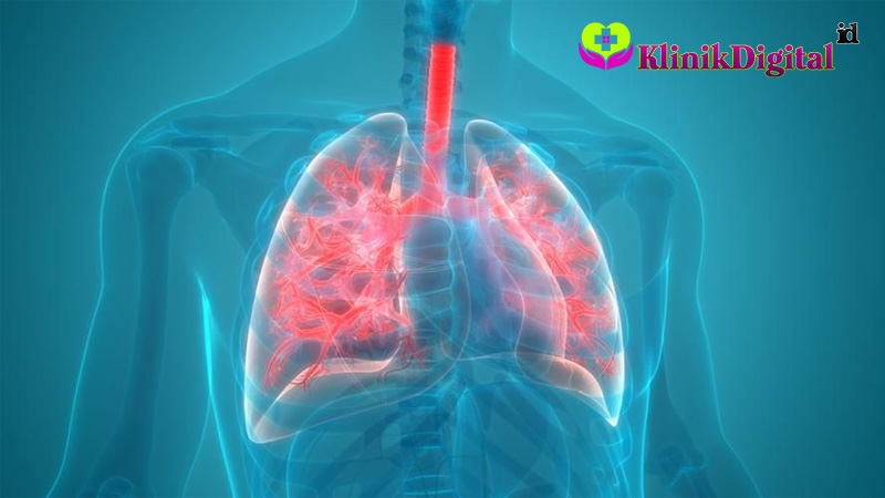 Mengenal Pneumonia Bilateral dan Pengobatannya