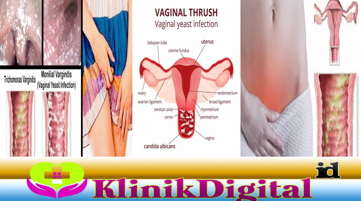 Infeksi Jamur Vagina Beserta Gejala dan Penanganannya