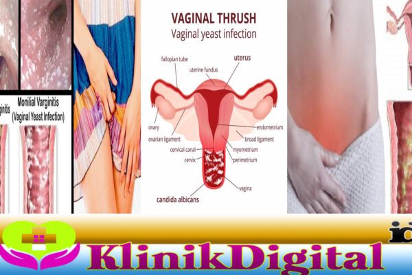 Infeksi Jamur Vagina Beserta Gejala dan Penanganannya
