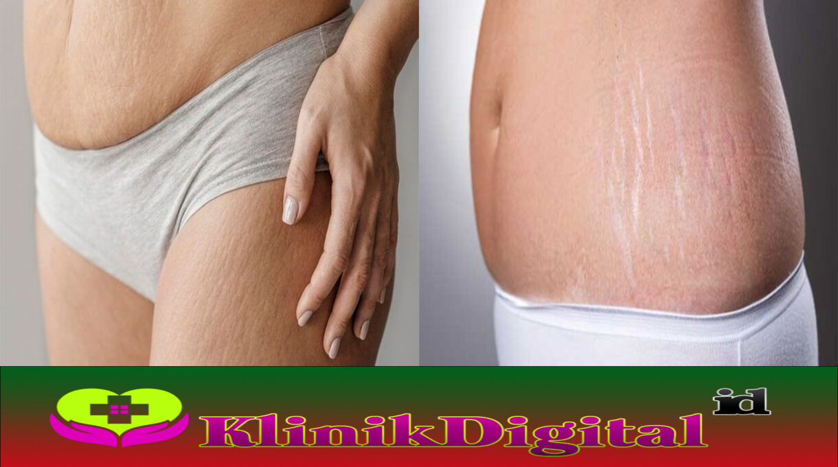 Penyebab Stretch Mark dan Ketahui Cara Mencegahnya