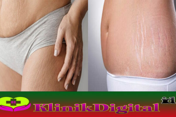 Penyebab Stretch Mark dan Ketahui Cara Mencegahnya