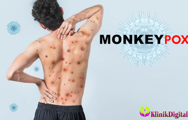 Cara Mengatasi Penyakit Cacar Monyet