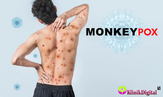 Cara Mengatasi Penyakit Cacar Monyet